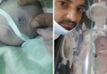 Seorang Bayi Bermata Satu Lahir di Yaman, Tanda Akhir Zaman?