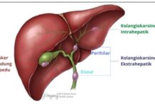 Batu Empedu Disebabkan Apa, Inilah Penjelasannya