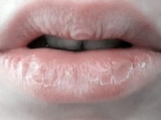 Sebabkan Kulit Kering, Jangan Biasakan Menjilat Bibir!