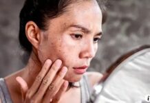 Inilah 6 Kesalahan yang Bikin Flek Hitam di Wajah Makin Parah Menurut Ahli